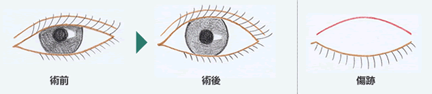 眼瞼下垂修正図