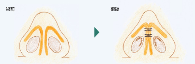 鼻尖縮小図