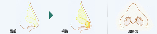 鼻中隔延長図