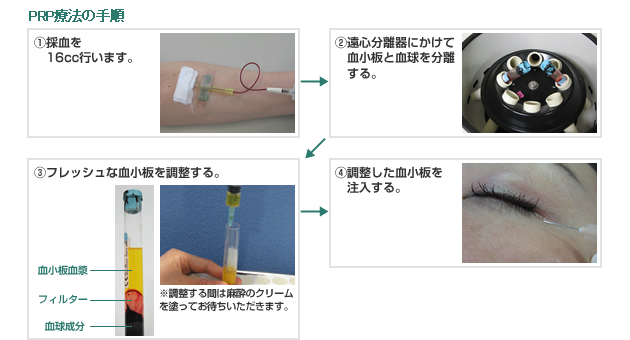 PRP療法の手順